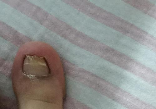 拔甲之后指甲怎么办