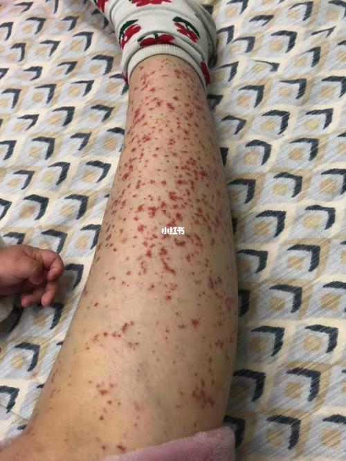 什么是过敏性紫癜?
