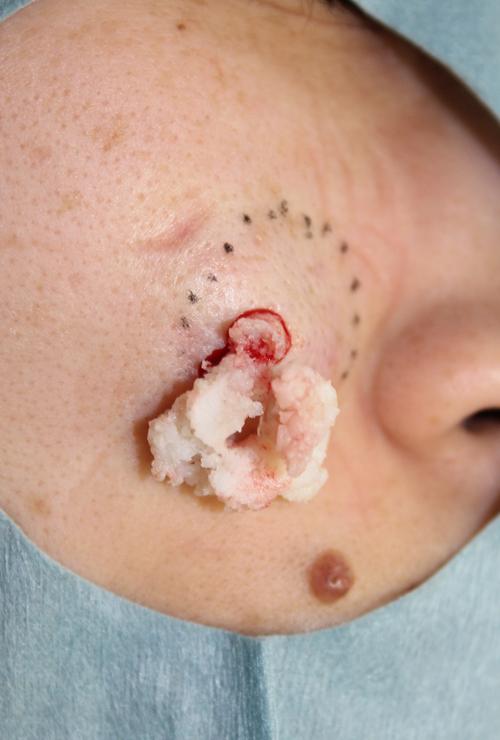 粉瘤- ssクリニック - 皮肤科99美容外科 - 名古屋市中区