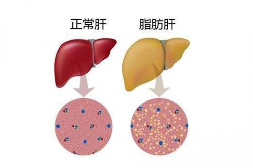 脂肪肝的危害性超乎想象,应该如何正确消除脂肪肝