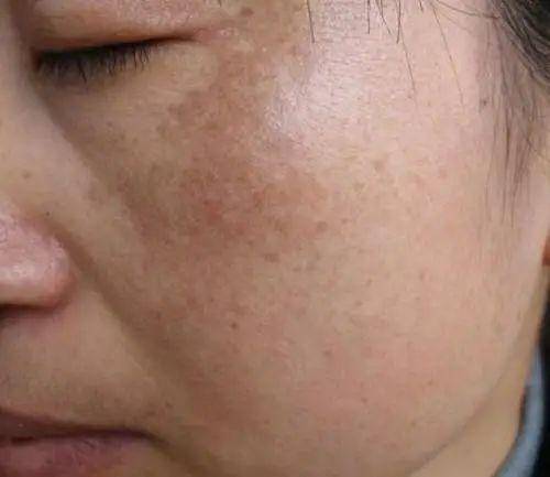祛斑难去雀斑黄褐斑更是难祛斑一定要分清雀斑和黄褐斑