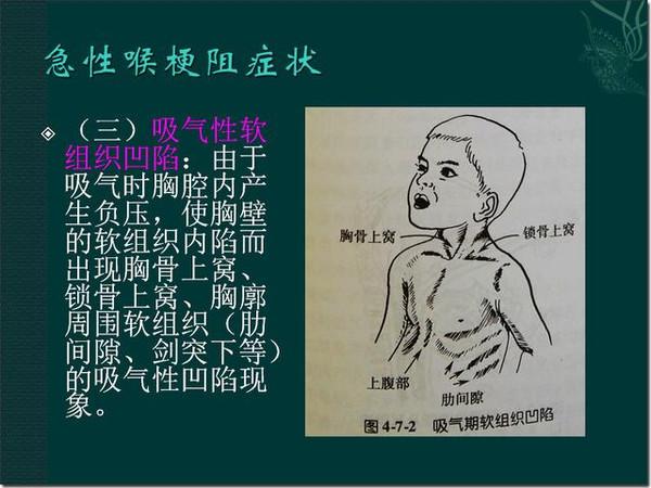 急性喉梗阻诊治