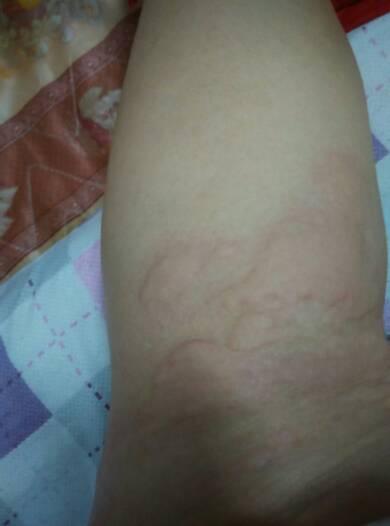 46 不是湿疹是叫什么毒我现在记不起了以前我姑生 小孩时也有越挠也