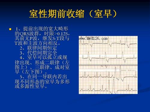 文档网 所有分类 医药卫生 各种心电图ppt课件 室性期前收缩(室早) 室
