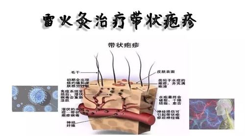 雷火灸治疗带状疱疹 写美篇 一,中医认识: 祖国医学称为"缠腰火丹","