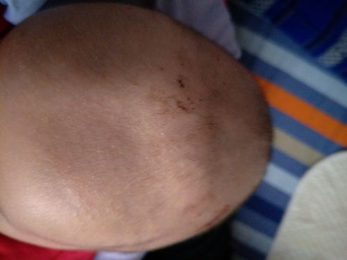不能确定是方颅,建议先观察,方颅是一个中医病症名.指小儿头颅