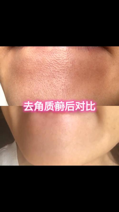 前后对比实拍_去角质啫喱