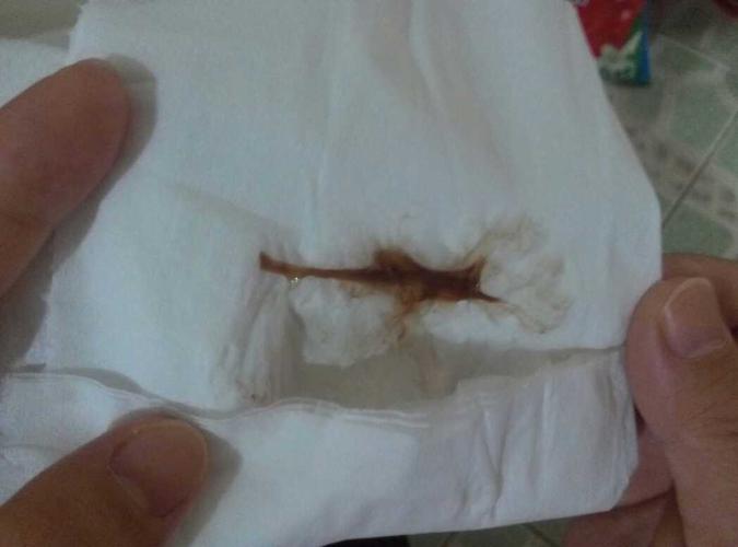 这是血么,像白带一样的褐色粘液,小腹疼疼的.该怎么办