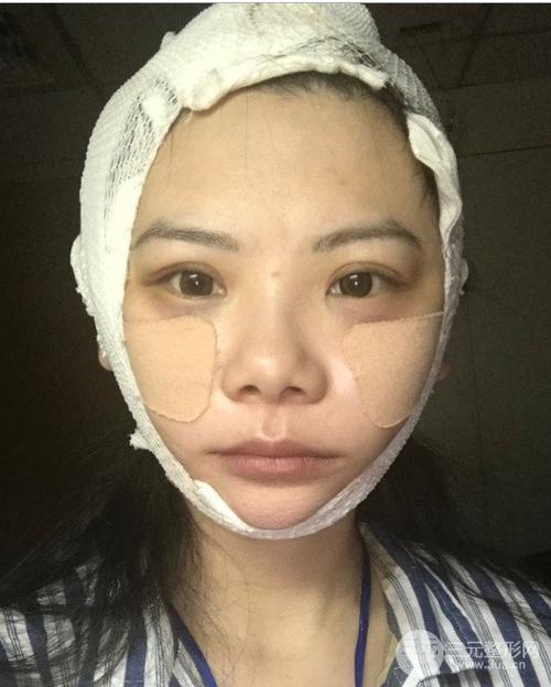 磨颧骨前后对比图 磨颧骨恢复案例分享