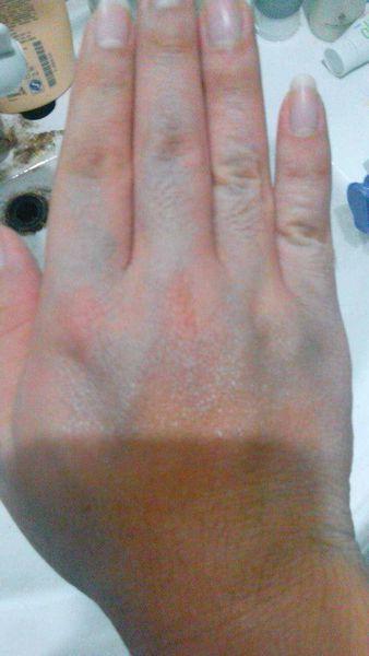 我的手的血管越来越发青,请问这是怎么回事啊?