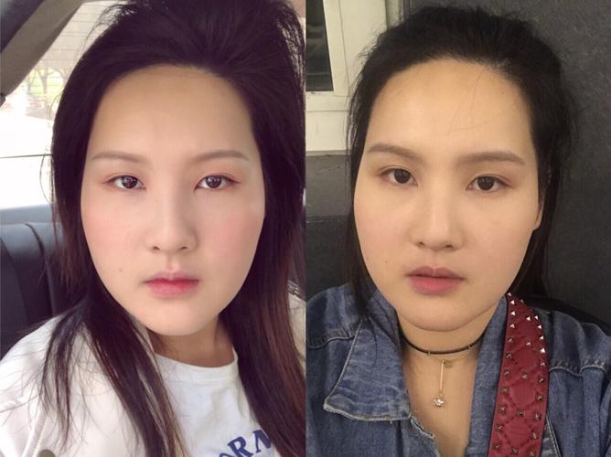 和没有水肿图片对比脸部水肿图片对比面部水肿对比脸部水肿照片对比