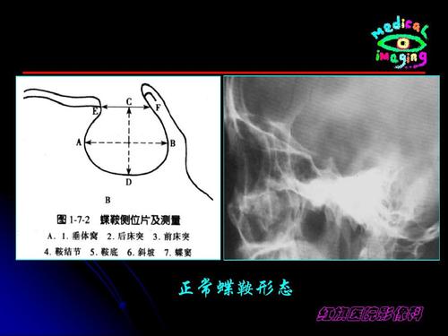正常蝶鞍形态 红旗医院影像科