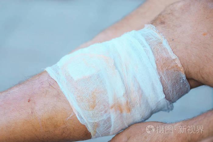 在受伤腿上涂绷带的过程