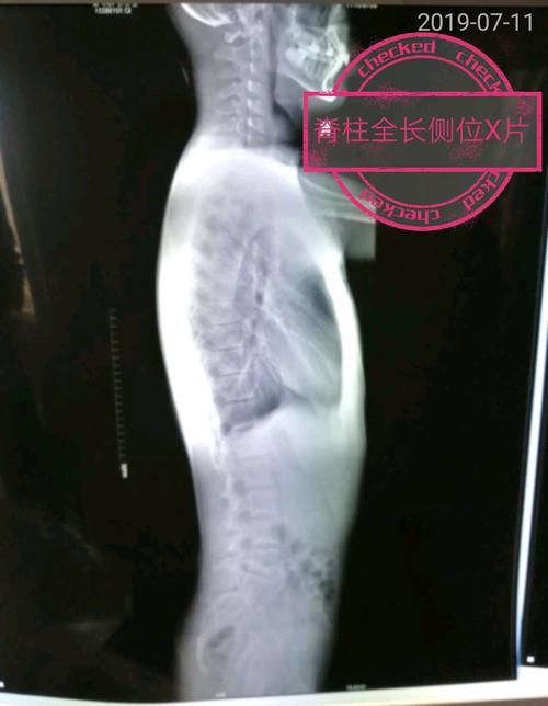 19岁男孩脊柱侧弯脊柱全长正侧位x片如下查看视频观看具体治疗手法