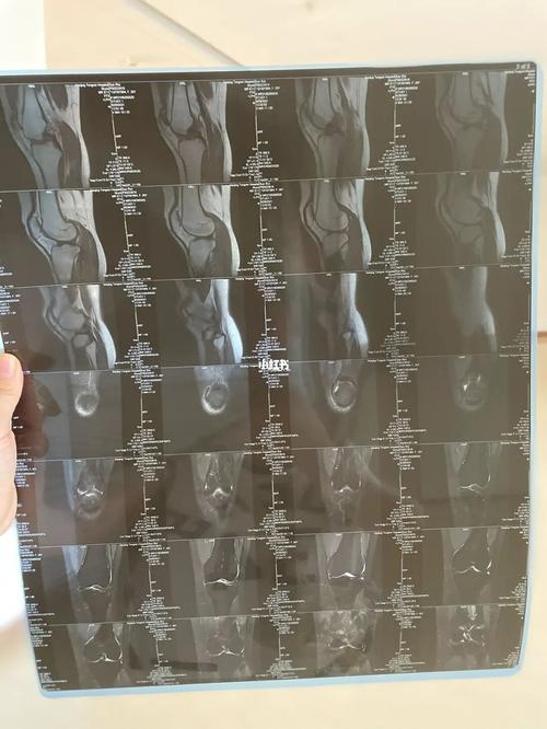 为什么我的核磁共振看不出来半月板撕裂几级_中医_半月板撕裂_医疗