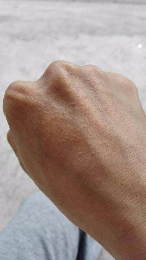 长治协和医院怎么样?我这个是紫外线过敏吗,手背布满红颗粒,帮忙看下