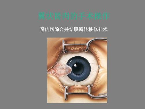 翼状胬肉的手术摘要.ppt