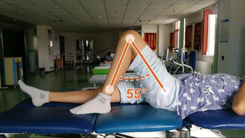 【康复园地】髌骨骨折术后——疼痛且活动受限,经系统康复训练效果