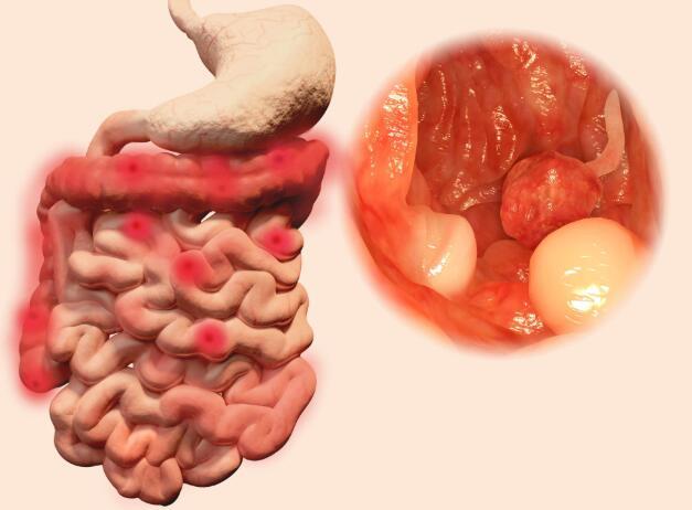 1,重视肠道息肉