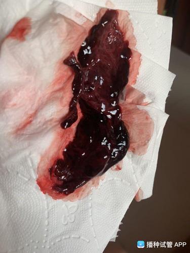 [试管婴儿]药流第三天,就当天排出孕囊,下