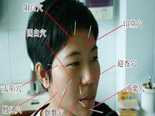 康复科对面神经麻痹及面神经炎的患者针灸治疗