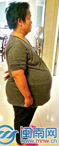 入院时,身高153cm的姚女士腹围达到158cm