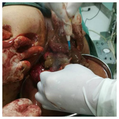 贵州省遵义市第一人民医院肛肠科"巨大坐骨结节囊肿"病例手术分享