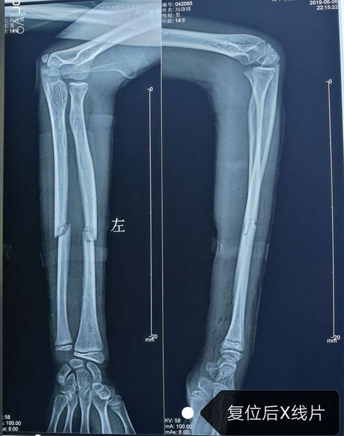 尺桡骨中段骨折