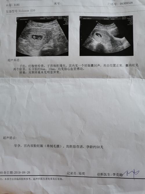 检查结果确定是同卵双胞胎,不能确定是单绒单羊还是单绒双羊.