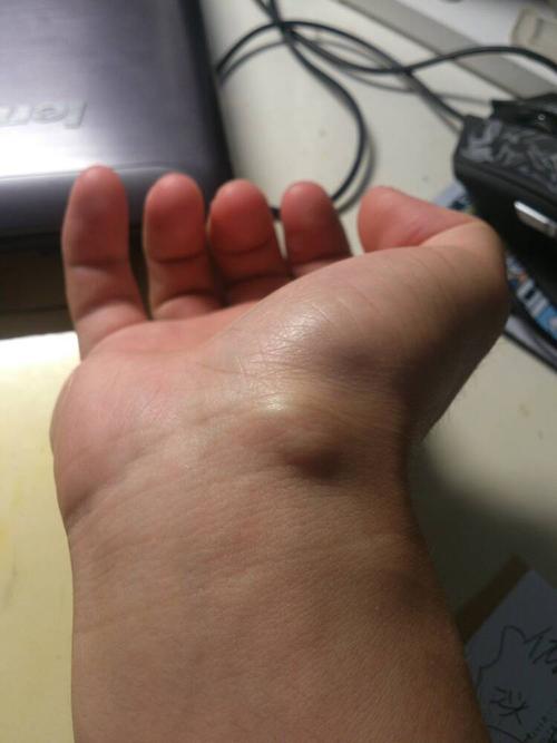 问:手腕正面桡侧起了个硬结节 伸腕时突出 屈腕时消失 平时无感觉
