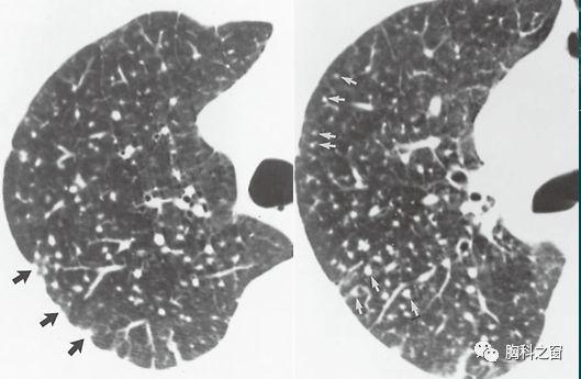 专家手把手教你看图说话肺间质疾病
