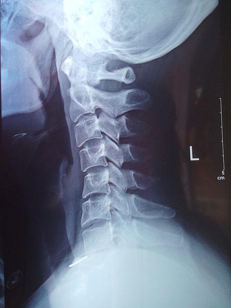 本人,女,年龄30,多年的颈椎病,但是没拍过x光片,没去医院看过…现在肩