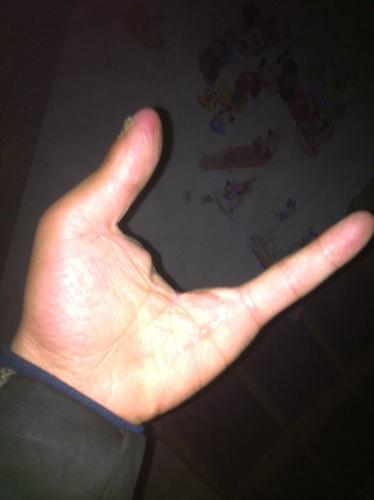 左手手指断三个可以考驾照吗?安徽宿州的