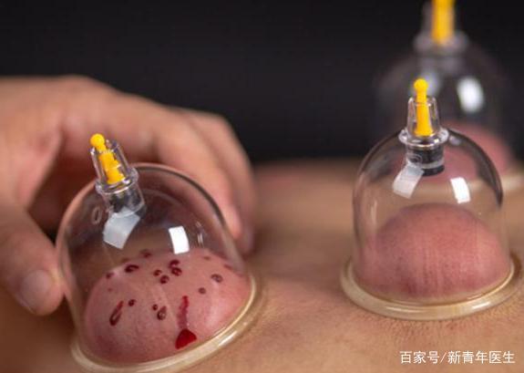 什么时候刮痧,拔罐比较好?有什么注意事项?哪些人不适合?