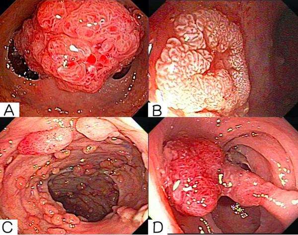 挑战三:请从下面   张图片中选出  带蒂息肉