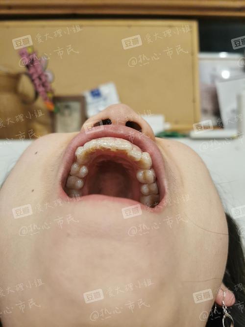 正畸前(上牙弓排列)08 版权所有正畸3个月08 版权所有正畸前08