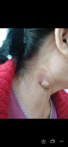 请问下大家有没有见过这种情况脖子上疙瘩3个月了昨天发现突出