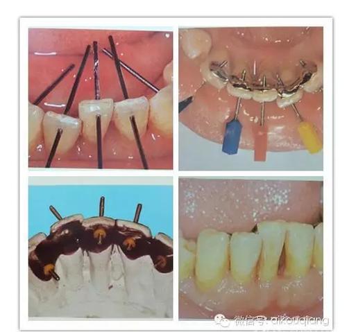 介绍一种老调新弹的松动前牙固定术