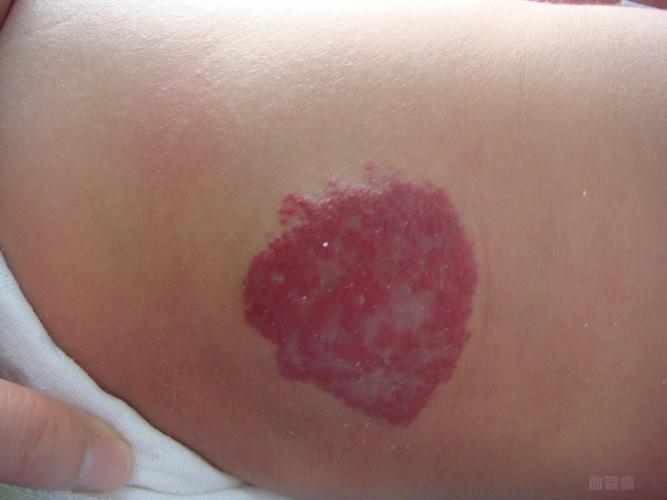 背部血管瘤的症状有哪些 如何治疗