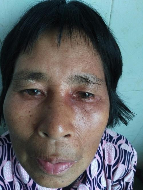 手术,鼻内镜下鼻腔泪囊造口术dcr 写美篇 这个是额筛囊肿合并鼻泪管