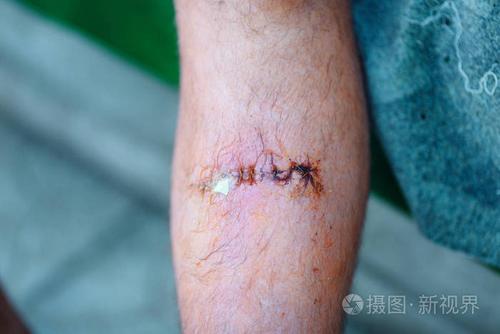 男性腿上缝合的伤口