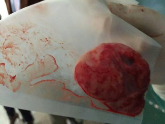 本人女,24,去年8月份查出右附件囊肿,到今年三月期间月经隔两三个月不