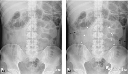 急诊卧位及立位腹平片正常气腹小肠梗阻前哨肠曲