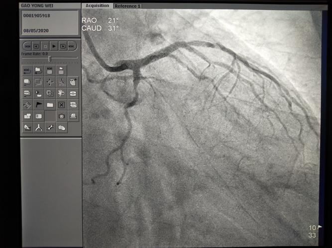 今天下午冠脉造影示lcx 可疑om 2近端100%闭塞,但无法判断断端.