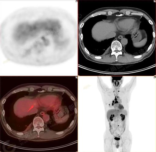 高尚案例petct肿瘤分期低分化肺腺癌小结节大转移两例