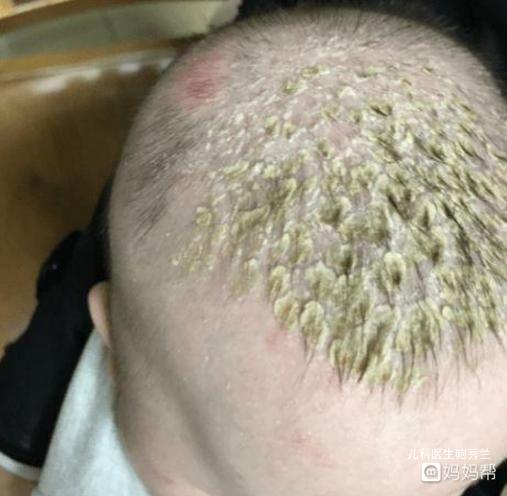 宝宝有脂溢性皮炎,要如何护理?