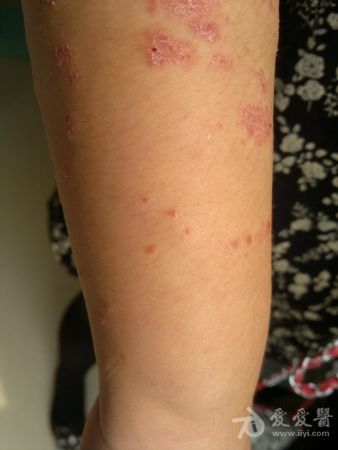 全身反复起鳞屑性斑丘疹斑块伴瘙痒疼痛18年