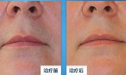 广州激光脱唇毛的效果可靠吗?