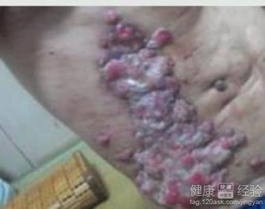 淋巴癌最后是怎么死亡