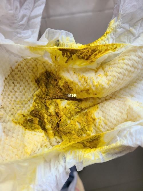 求助98,宝宝拉屎有奶瓣带血丝_益生菌_雅安市人民医院_拍嗝_混合